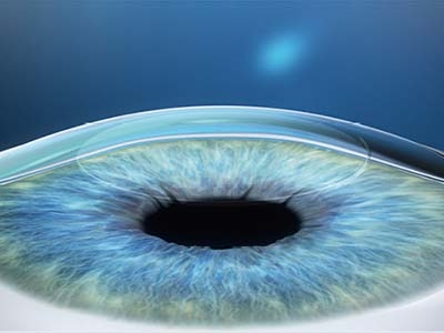 La lunghezza assiale risulta così corretta, con conseguente correzione del difetto visivo e dell’astigmatismo.