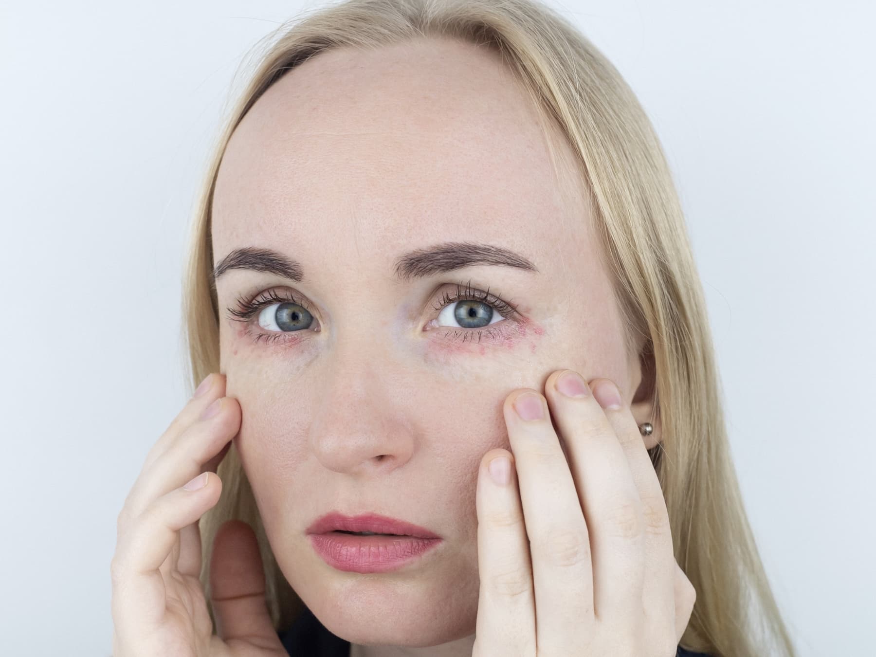 Rosacea oculare e occhi secchi: quando la causa non è dove ce l’aspettiamo 