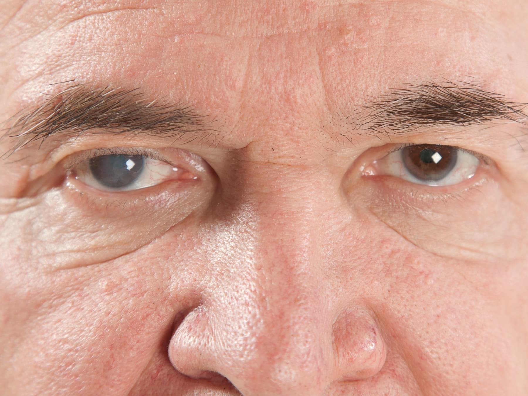 Glaucoma: un pericolo per la vista che non avverte 