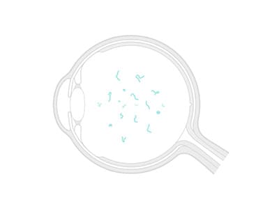 Vitreolisi laser 