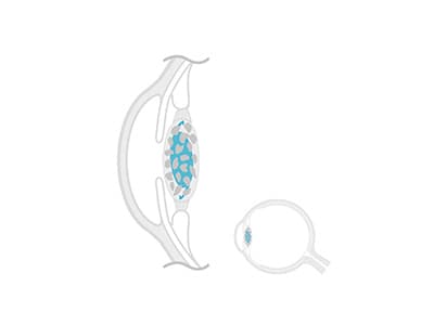 Capsulotomia con YAG laser 