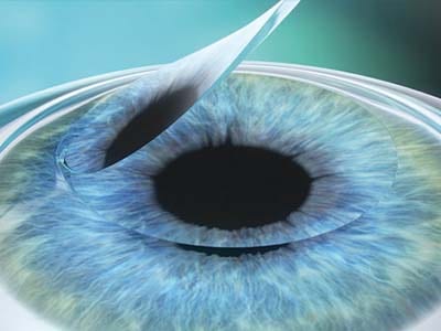 Femto LASIK, la metodica di chirurgia refrattiva laser