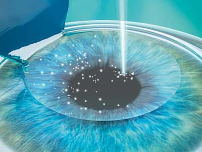 Femto LASIK, la metodica di chirurgia refrattiva laser