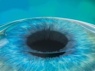 Femto LASIK, la metodica di chirurgia refrattiva laser