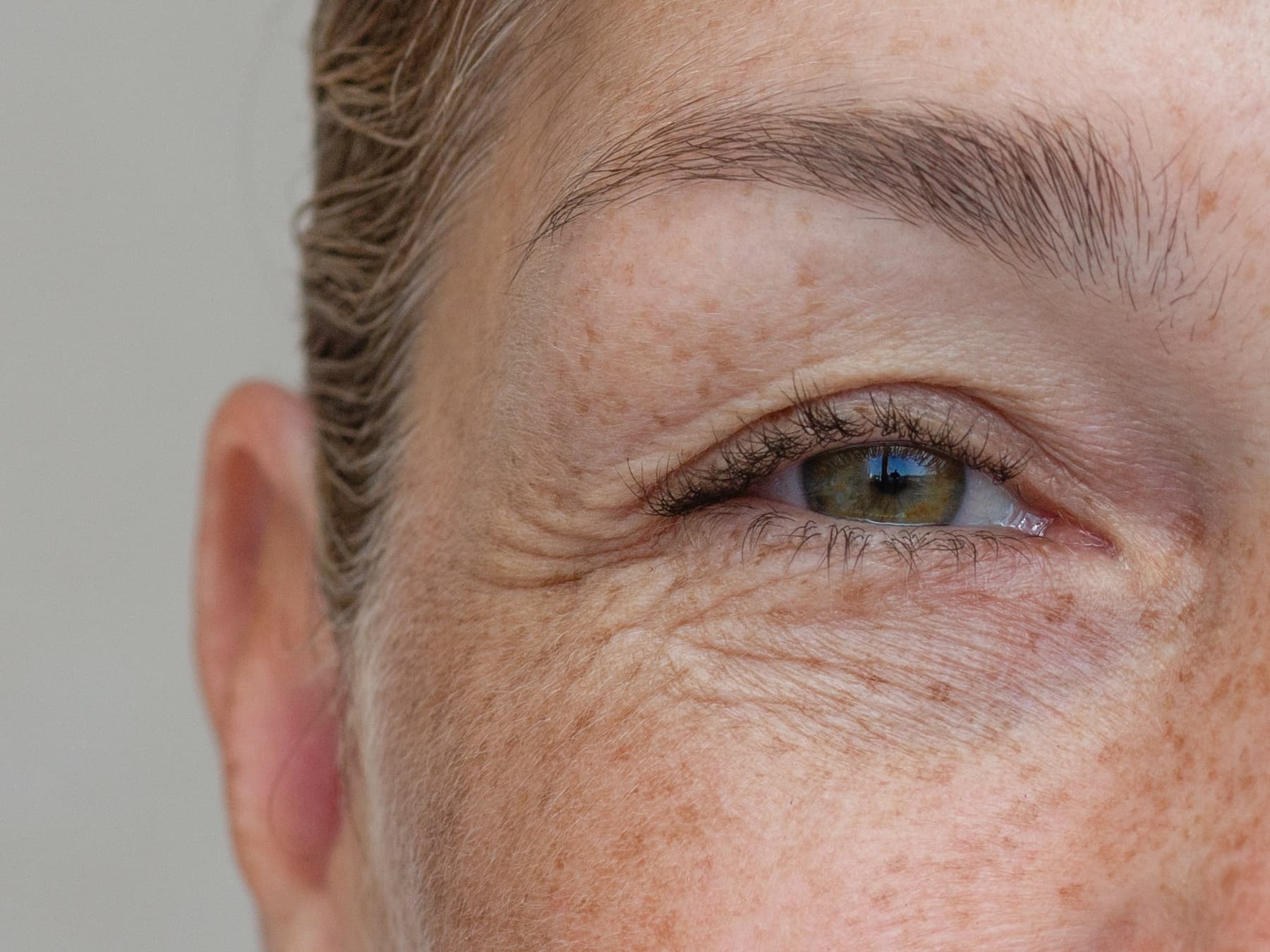 Quando è il momento giusto per una correzione chirurgica delle palpebre?