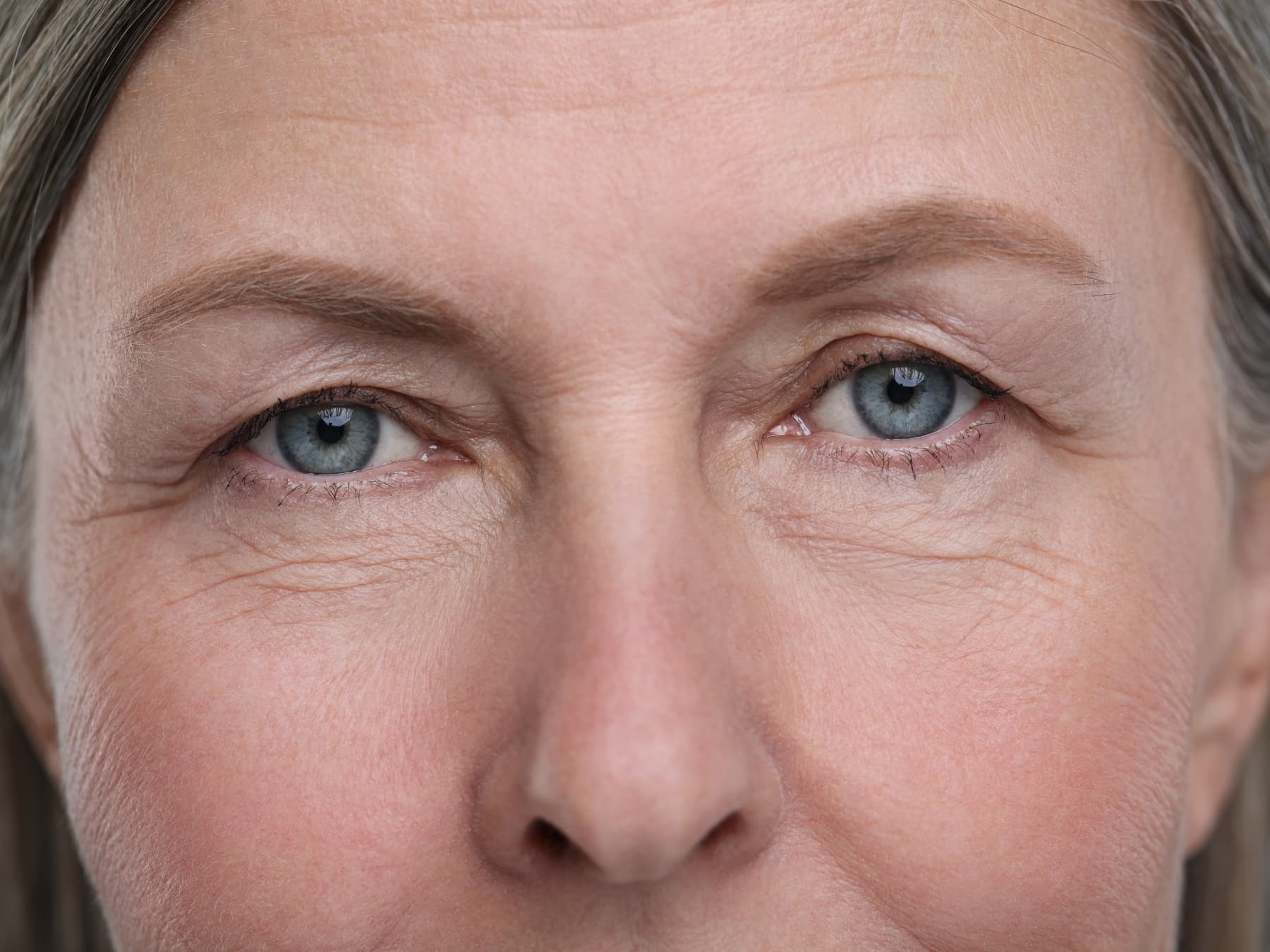 Cinque fatti sull’intervento per le palpebre cadenti