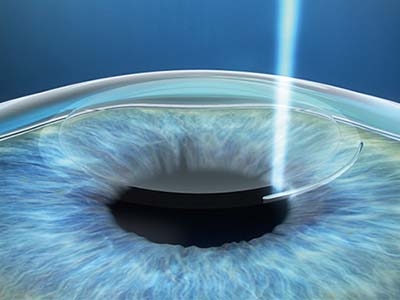 Il laser a femtosecondi Zeiss Visumax 800 crea il lenticolo nello strato intermedio della cornea.