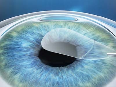 Il lenticolo viene estratto attraverso un’incisione di pochi millimetri con l’ausilio di un apposito strumento microchirurgico.